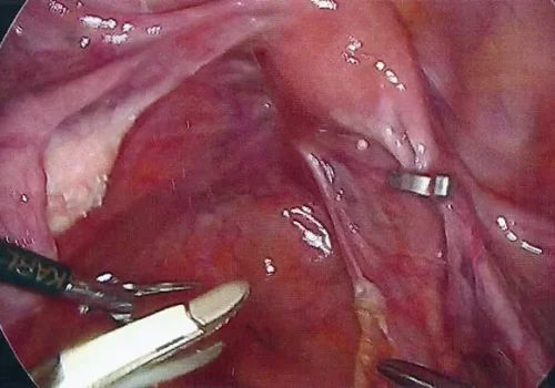 The laparoscopic view of the pelvis at the start – uterus, ovaries and tubes (incidentally, there is a clip on the right Fallopian Tube for sterilisation)