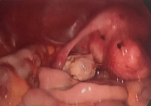 The laparoscopic view of the pelvis - the fibroid on the posterior wall of the uterus.