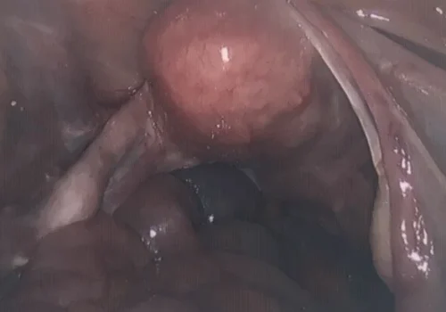 The laparoscopic view of the uterus..