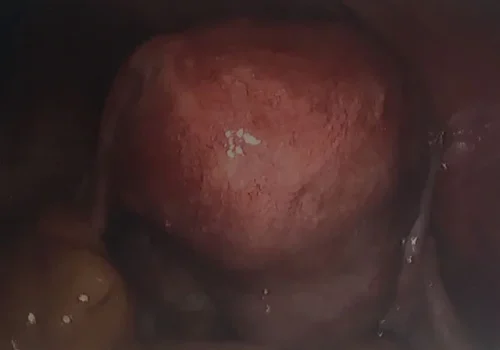 The laparoscopic view of the uterus.
