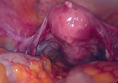 The laparoscopic view of the uterus.