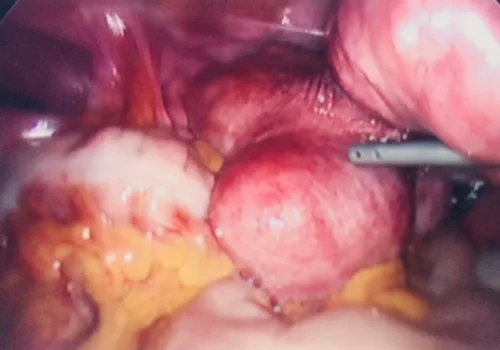 The laparoscopic view of the uterus showing multiple fibroids. In particular, there is a right sided pedunculated fibroid.
