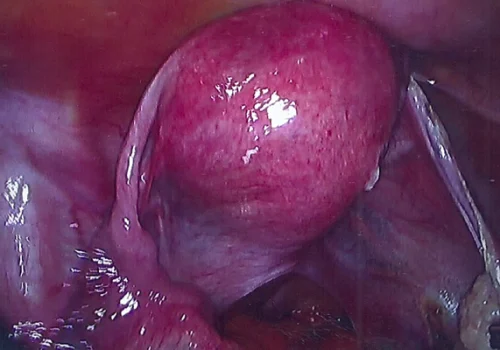 The laparoscopic view of uterus