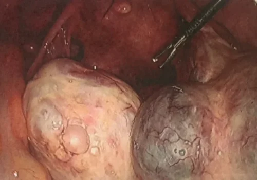The large bilateral ovarian cysts at the start of the procedure.