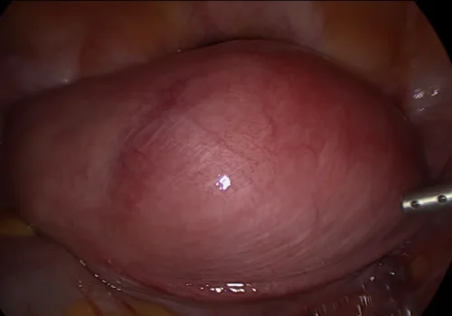 The large fibroid at the top of the uterus