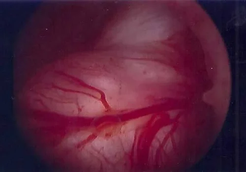 The large fibroid in the cavity of the uterus. Large blood vessels are noted on the surface
