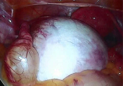 The large left ovarian cyst is in front of the uterus.