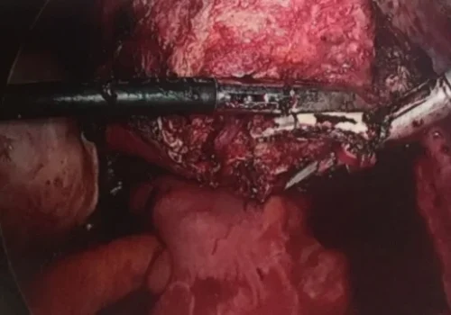 The large uterus was detached from the cervix to facilitate access - a modification of the standard technique because of the large fibroid.