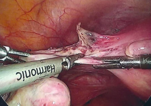 The left Ovarian Ligament is divided