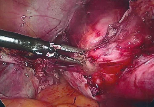 The left Uterine Artery pedicle is divided.