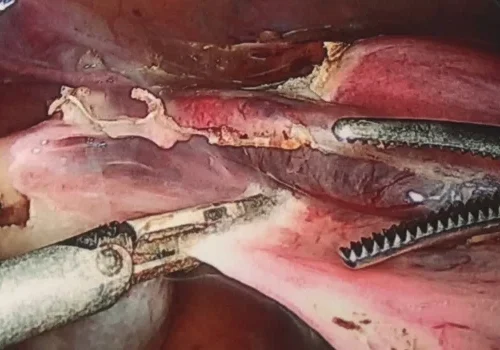 The left broad ligament pedicle is divided. The left ovary is preserved.