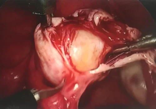 The left dermoid cyst seen within the ovary.