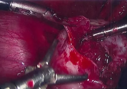 The left endometrioma is drained and stripped away.