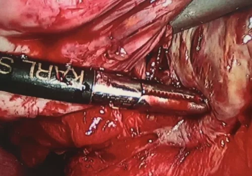 The left ovarian endometrioma is drained and the wall is stripped. The left ovary is mobilised.