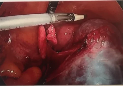 The left ovary and tube are removed intact.