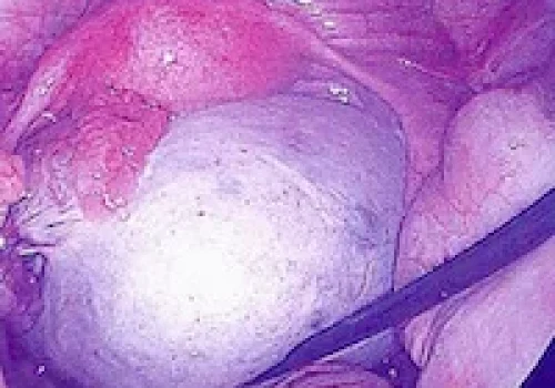 The left ovary continues to heal and will return to a normal appearance. The normal right ovary is now seen.