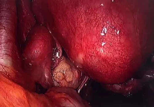 The left ovary is adherent to the left side wall.