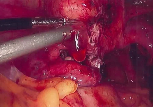 The left ovary is adherent to the left side wall. This is mobilized and underlying endometriosis is excised. This involves dissection in the Pouch of Douglas – near the rectum.