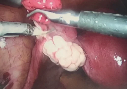 The left ovary is conserved.