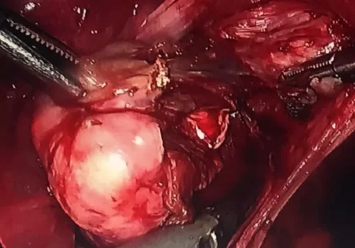 The left ovary is mobilised. A small endometrioma is noted and excised. The left ureter is dissected out and endometriosis on left side wall excised