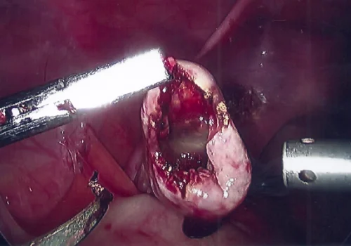The left ovary will gradually heal and return to a normal appearance