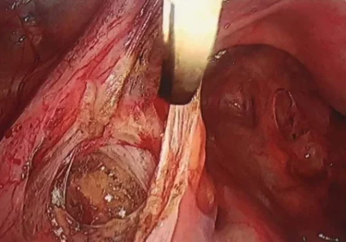 The left pelvic side wall is dissected and endometriosis excised.