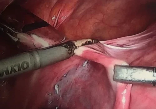 The left round ligament is divided.