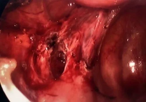 The left side wall endometriosis is excised. Careful bipolar has been done along the length of the left uteine artery.