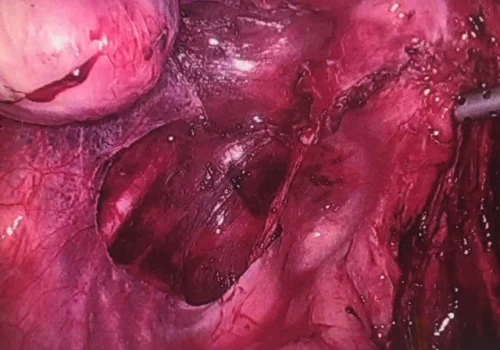 The left side wall endometriosis is excised. The left ureter has been dissected out