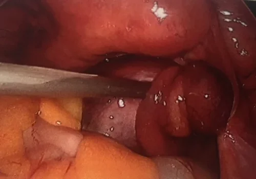 The left tubal cyst and left ovary have twisted around on the pedicle.