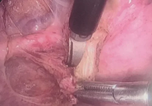 The left ureter has been dissected out.