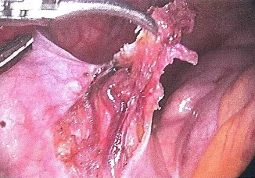 The left ureter is carefully dissected out and nodule of endometriosis excised