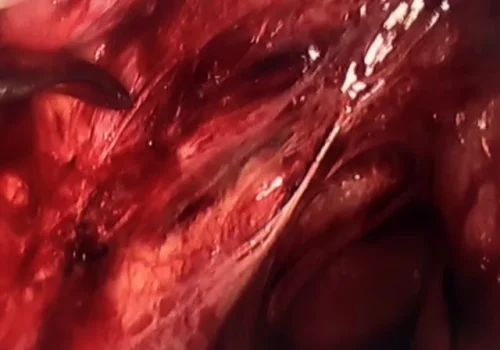The left uterine artery and left ureter have been dissected out to reveal endometriosis of the left side wall. The left uterine artery bleeding has been occluded with bipolar.