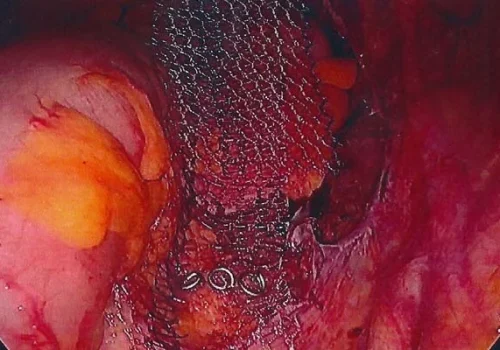 The mesh has been sutured to the front and back walls of the vaginal vault. This picture demonstrates tacking the mesh into the sacral promontory