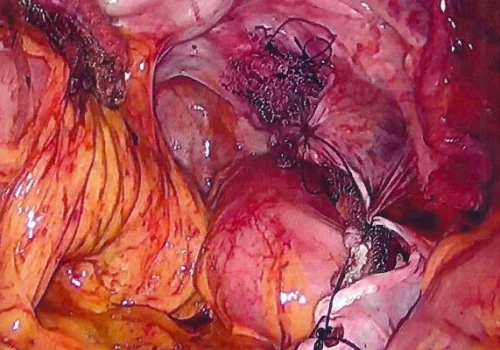 The mesh has been tacked into the sacral promontory for elevation of the vaginal vault. The peritoneum has been sutured over the mesh. The end of the procedure.