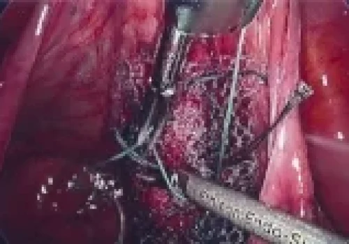 The mesh is sutured to the posterior cervix