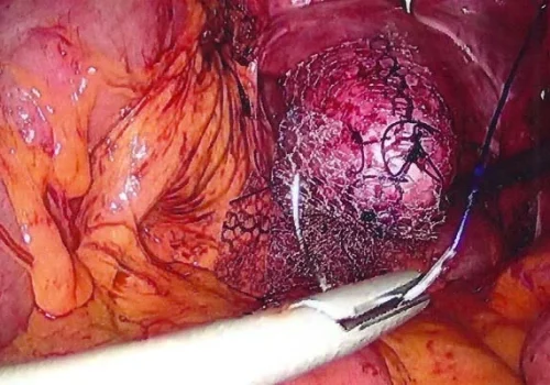 The mesh is sutured to the vaginal vault after the bladder has been cleared