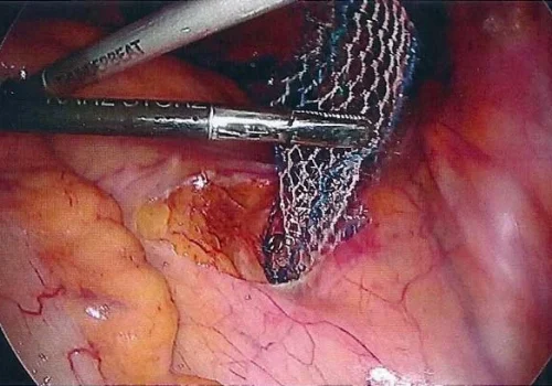 The mesh is tacked into the Sacral Promontory