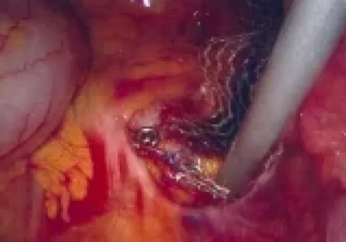 The mesh is tacked to the Sacral Promontory