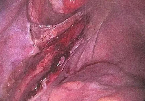 The nodule of endometriosis has been excised and the left ureter is seen running along the pelvic side wall