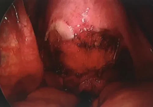 The nodule of endometriosis has been excised. The view of the pelvis at the end of the procedure.