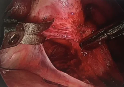 The nodule of endometriosis is being dissected out.