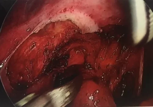 The nodule of endometriosis is being dissected out. Meticulous care is taken because the lesion is very close to the rectum.