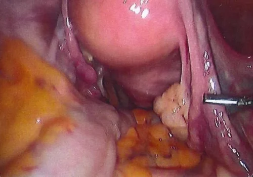 The normal appearing uterus at the start. The right ovary is clearly seen as a white structure