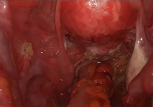 The (normal) bowel has been joined onto (normal) rectum. The end of the operation