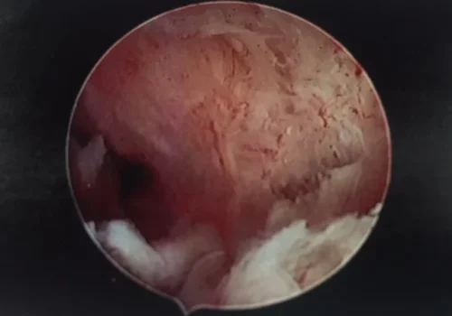 The normal cavity at the end of the procedure. All adhesions have been divided.