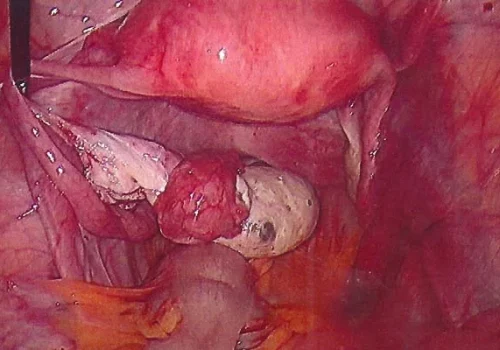The normal pelvis at the end of the procedure demonstrating a normal left ovary and tube
