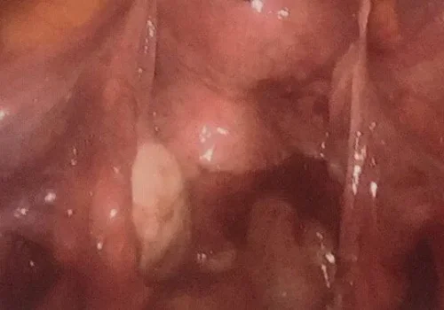 The normal pelvis at the end of the procedure...