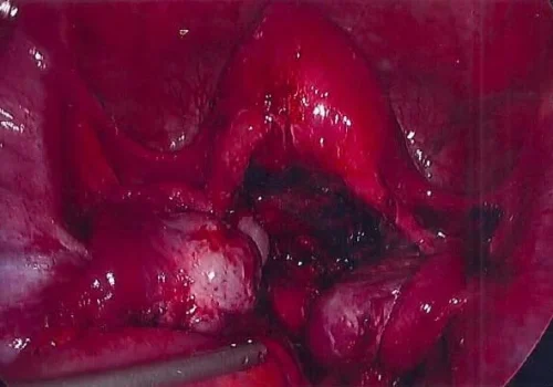 The normal pelvis at the end of the procedure. The uterus is now visible. Both ovaries are mobile and underlying endometriosis has been removed.