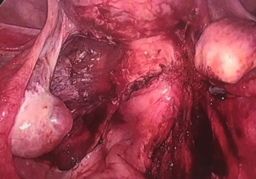 The normal pelvis at the end showing all endometriosis has been treated. There are two normal ovaries.